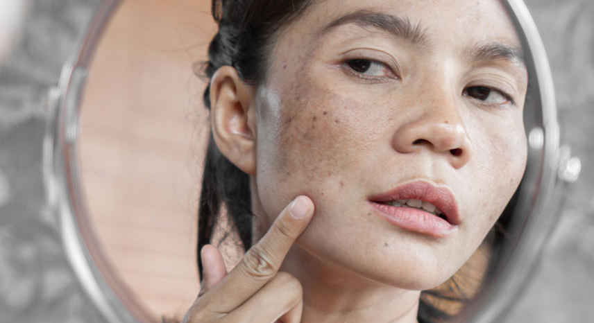 How to Get Freckle-Less Skin_ Tips, Treatments & Prevention for Clearer Skin