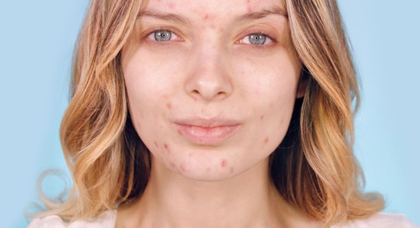 Embracing Acne_ Self-Love and Body Positivity Guide